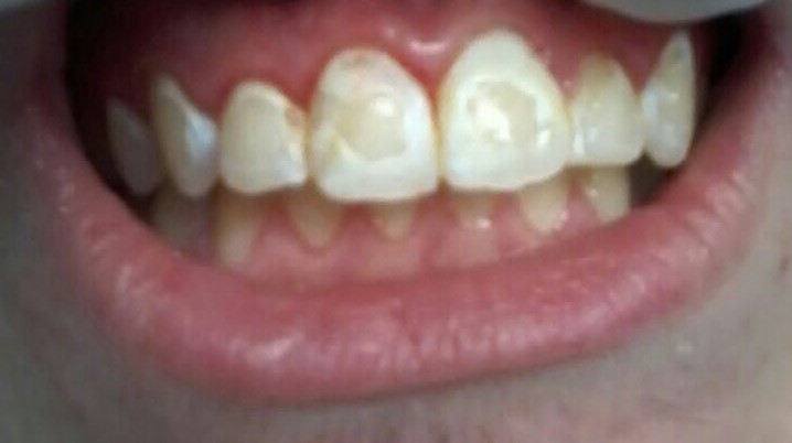 Boissons et drogues, quels effets sur les dents?